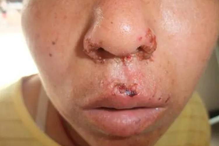 单纯疱疹鼻子症状图