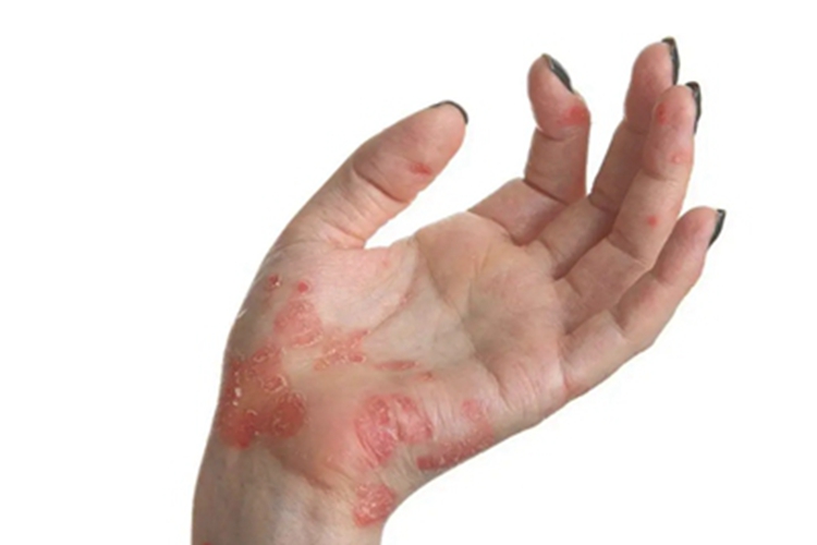 光毒性接触性皮炎手掌脱皮图
