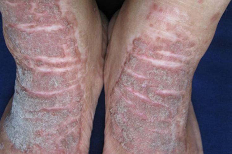 慢性苔藓样角化病红肿图