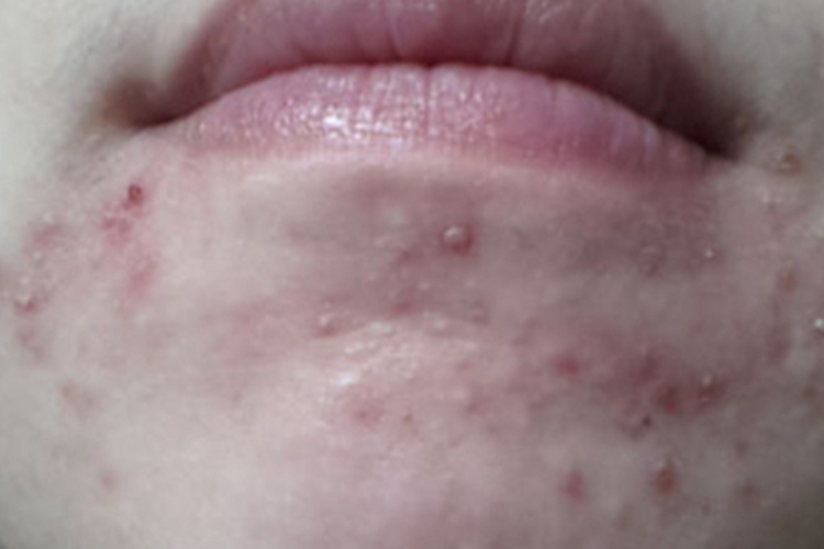 月经疹下巴症状图