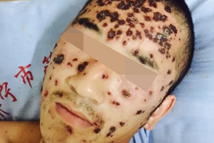 播散性马尔尼菲青霉病面部结痂图