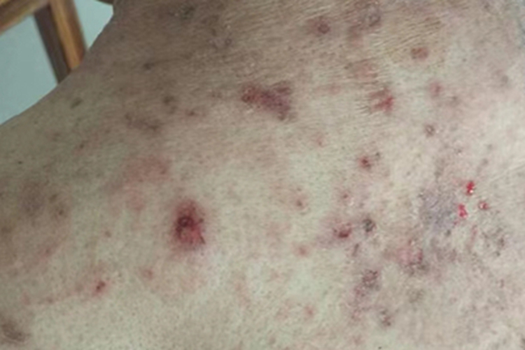 慢性湿疹背部糜烂图