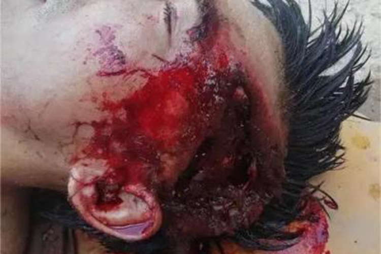 开放性颅脑损伤出血图 开放性颅脑损伤出血图