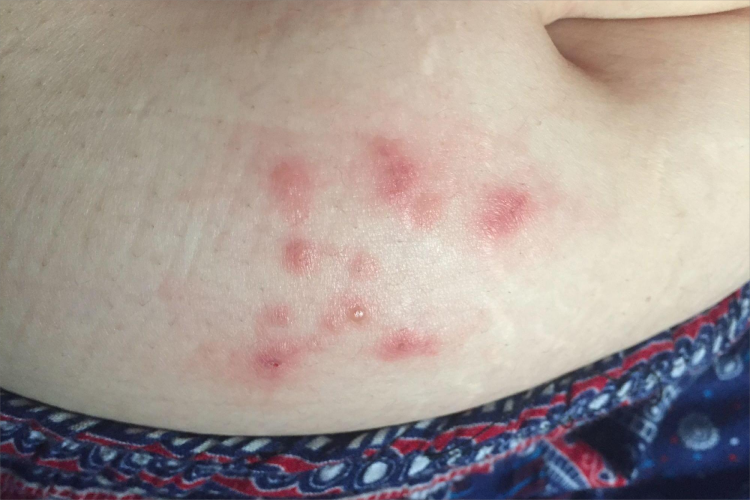 蚊虫叮咬腹部症状图 蚊虫叮咬腹部症状图