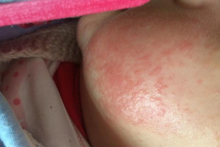 小孩蓝莓过敏症状图