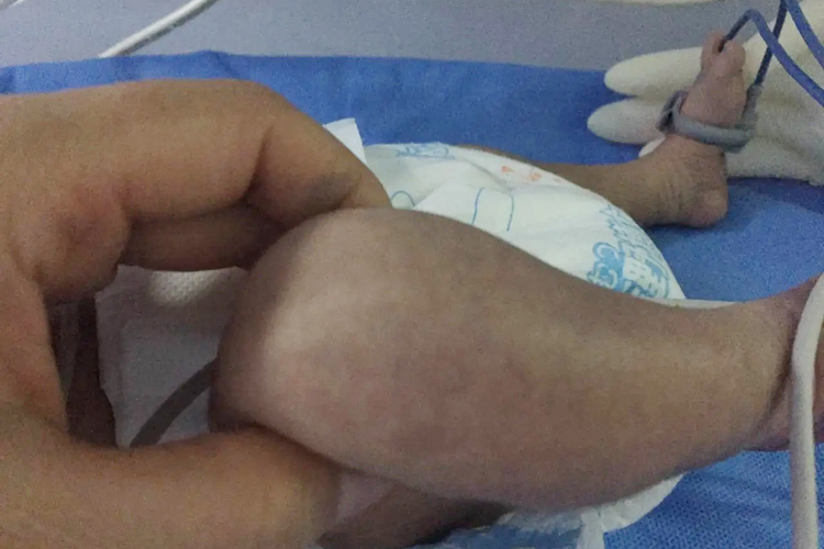 新生儿皮损蓝紫图