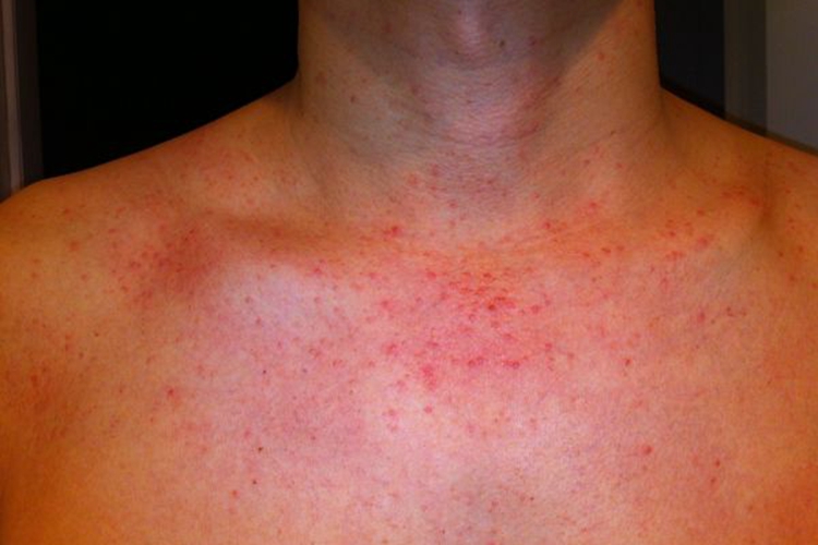 湿热毒引起的面游风图