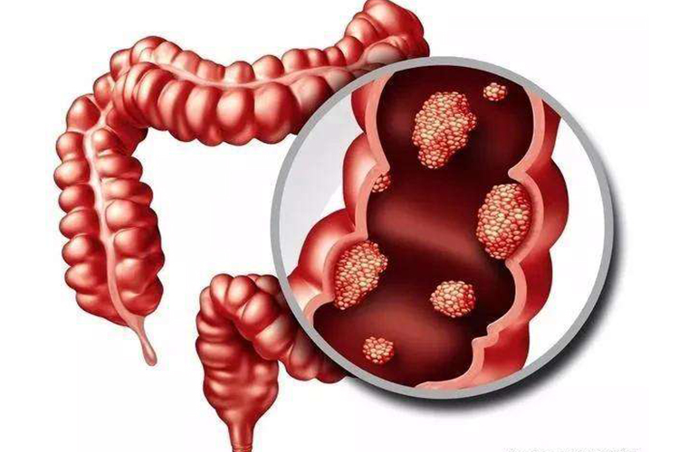 回盲部肠结核示意图