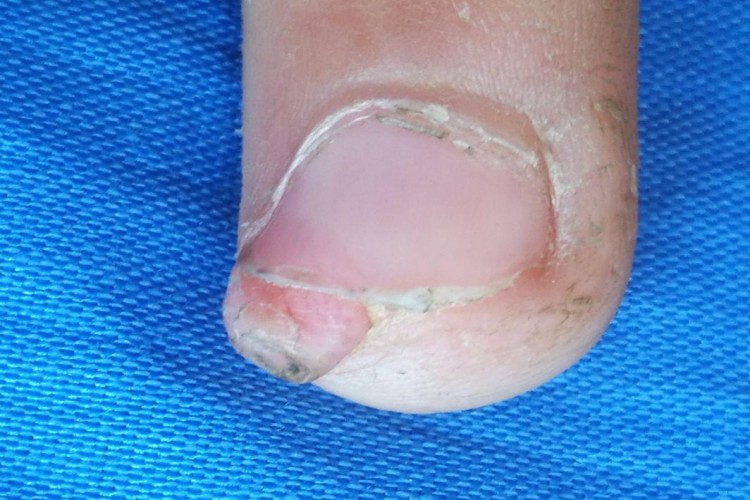 甲下外生骨疣手指尖症状图 甲下外生骨疣手指尖症状图