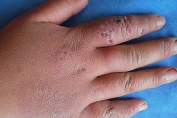 寒冷性多形红斑结痂图