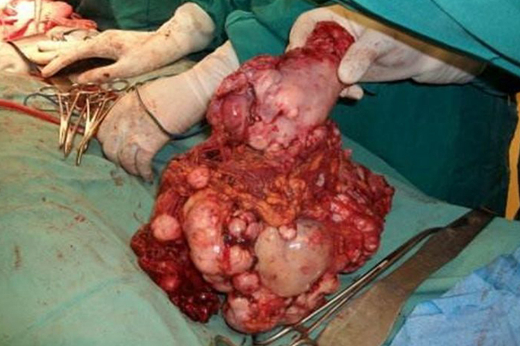 卵巢癌真实图 卵巢癌真实图