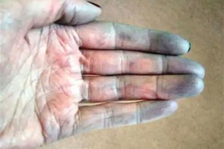 雷诺病手部症状图 雷诺病手部症状图