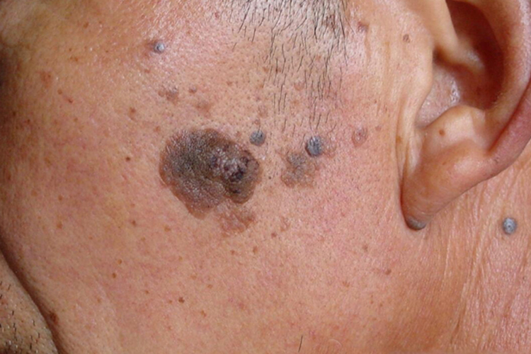 老年疣图 老年疣图