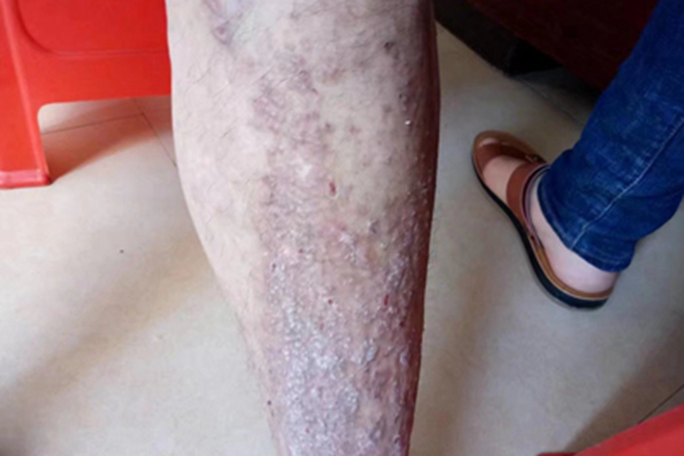 慢性湿疹小腿有密集丘疹图 慢性湿疹小腿有密集丘疹图