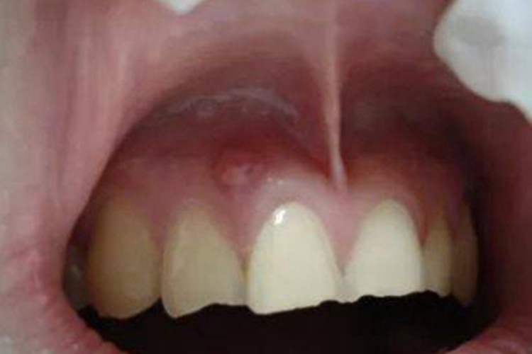 根尖囊肿牙龈上有个疙瘩图