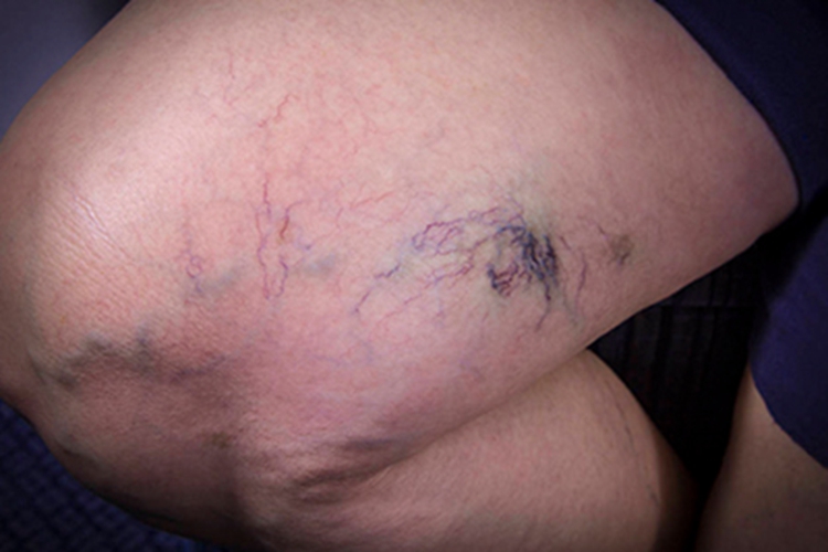 下肢静脉曲张红色筋图 下肢静脉曲张红色筋图