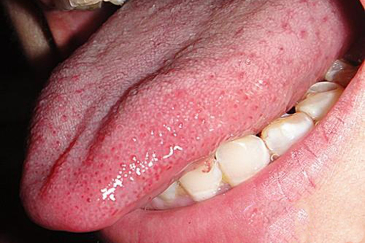 丝状舌乳头炎症状图片