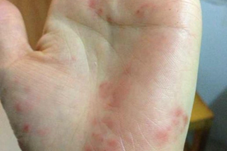 2级手足综合征手掌红斑图