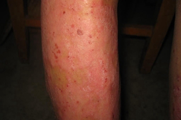 苔藓样型副银屑病小腿症状图