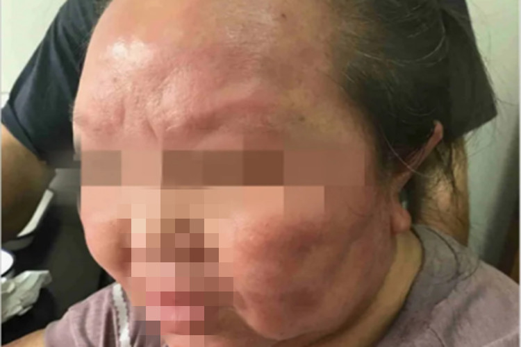 瘤型麻风症状图