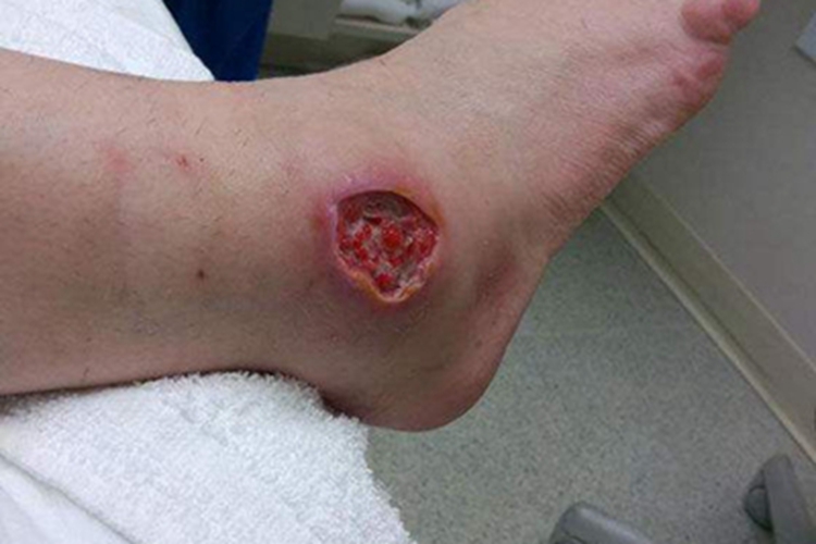 蜘蛛蜇伤组织坏死图