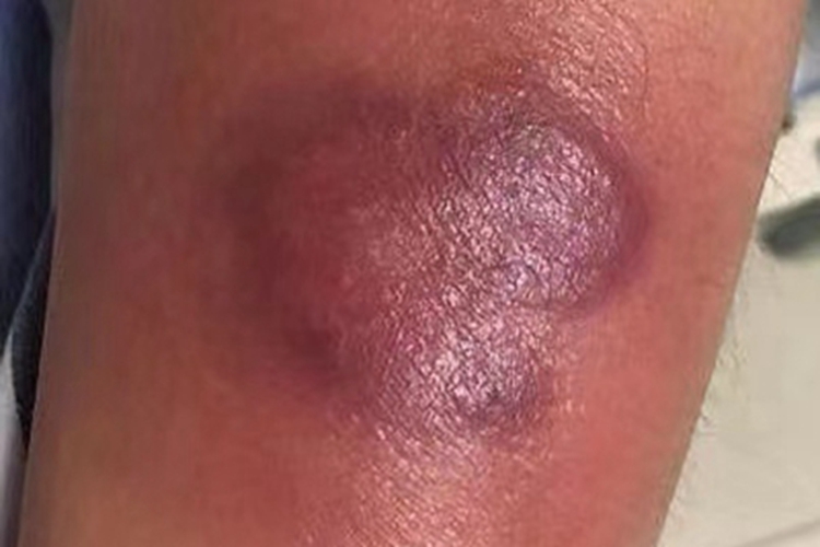 坏疽性蜂窝织炎小腿症状图 坏疽性蜂窝织炎小腿症状图