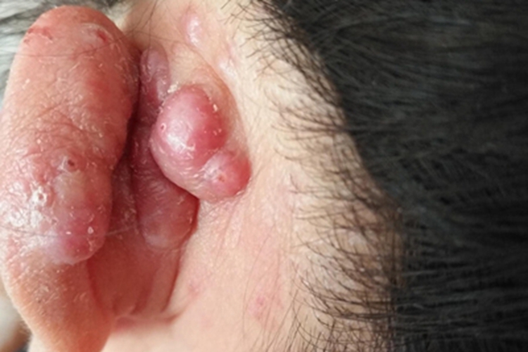 木村病耳后症状图