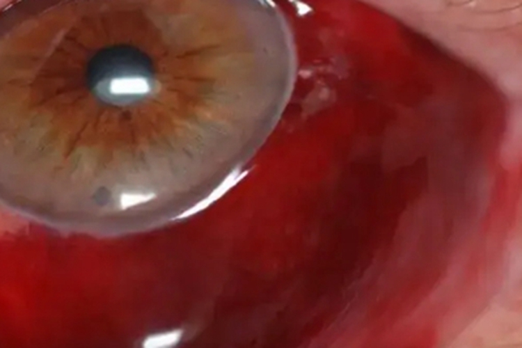 球结膜下出血症状图