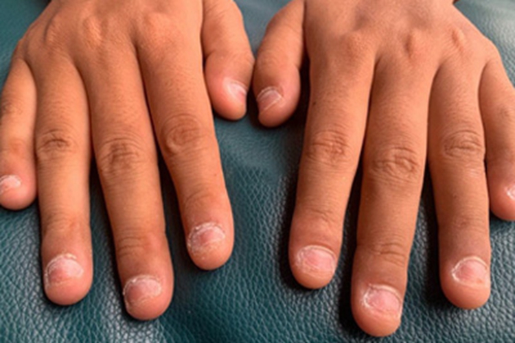 脱甲病手指甲缩小图 脱甲病手指甲缩小图