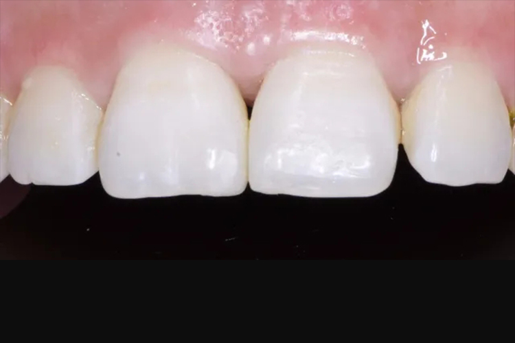 树脂补牙缝效果图