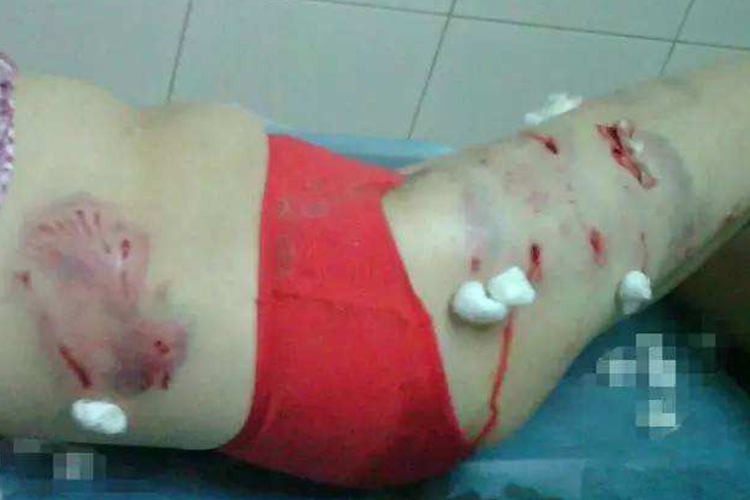 贯穿性皮肤抓伤图