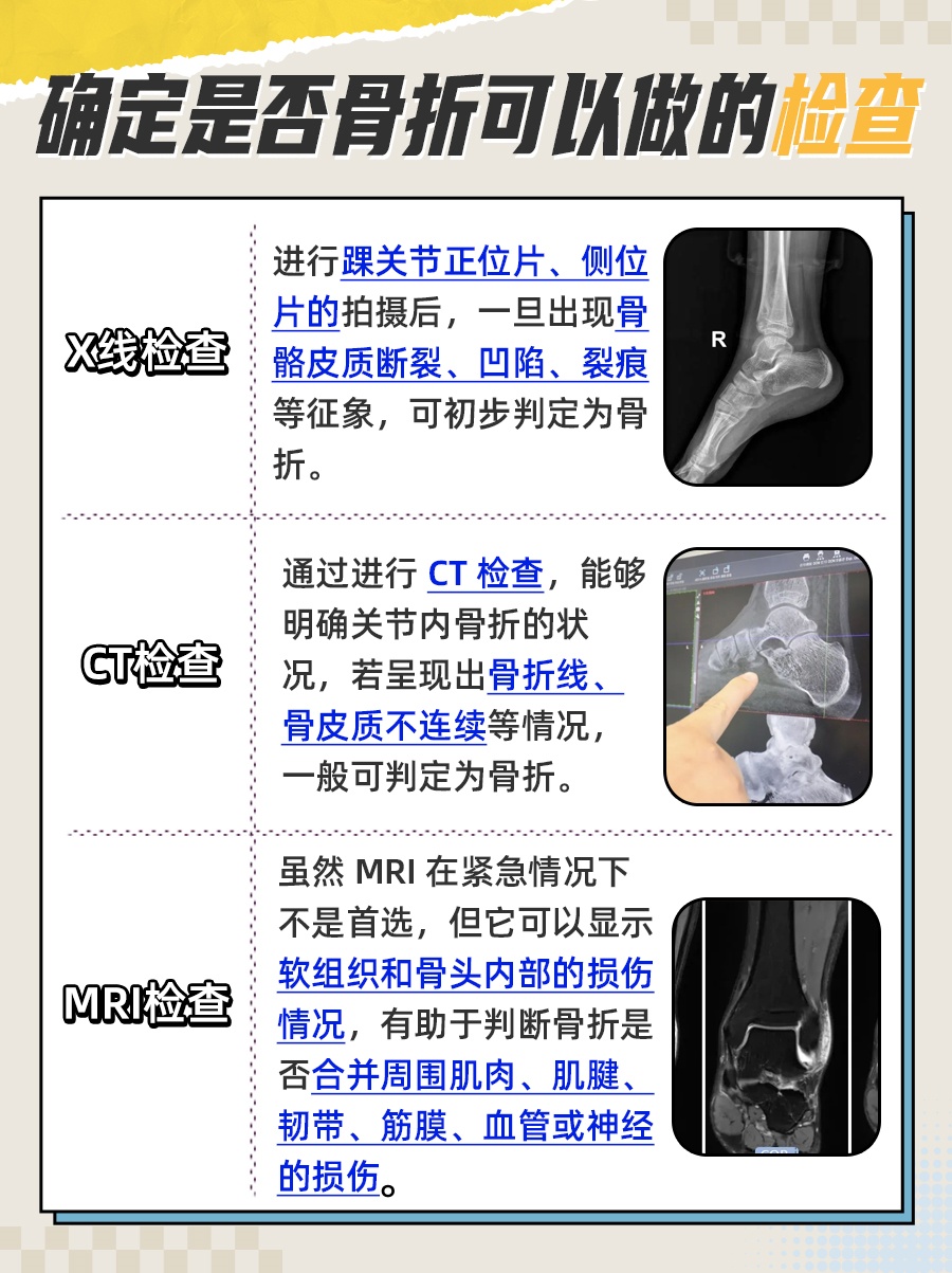 医生解答：崴脚了怎么知道有没有骨折