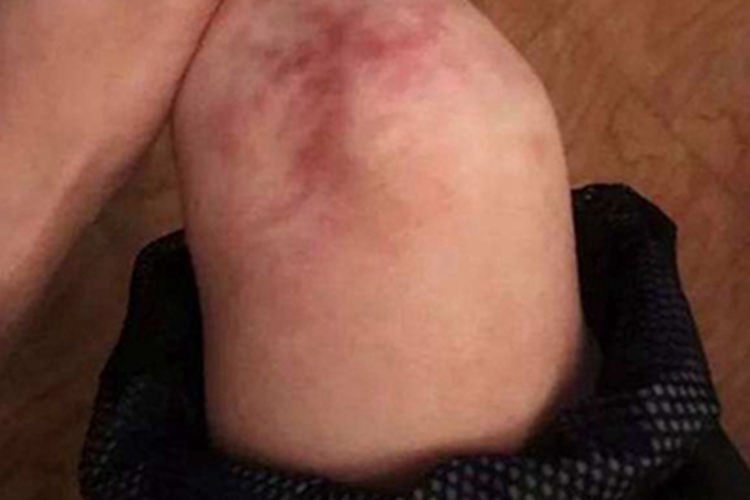 Ⅱ度冻伤膝盖红斑图