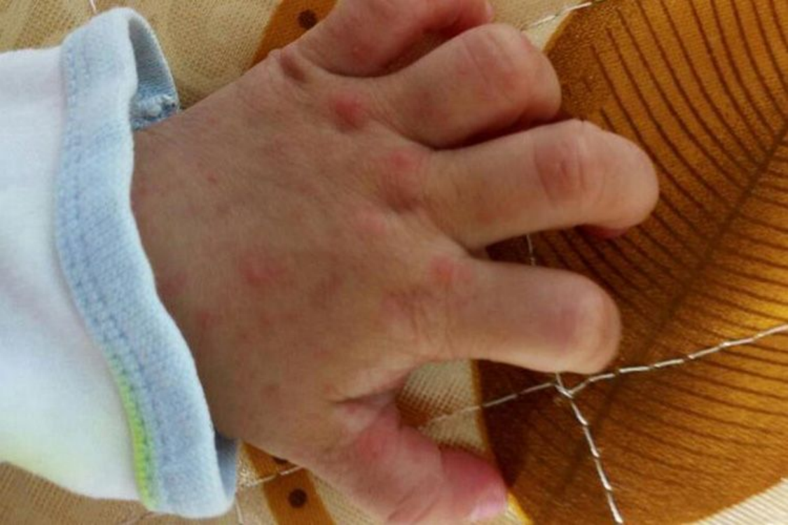 手足口病手背疹子图