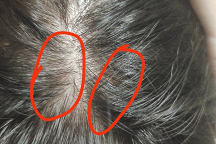 成人脂溢性皮炎头皮略微泛红图