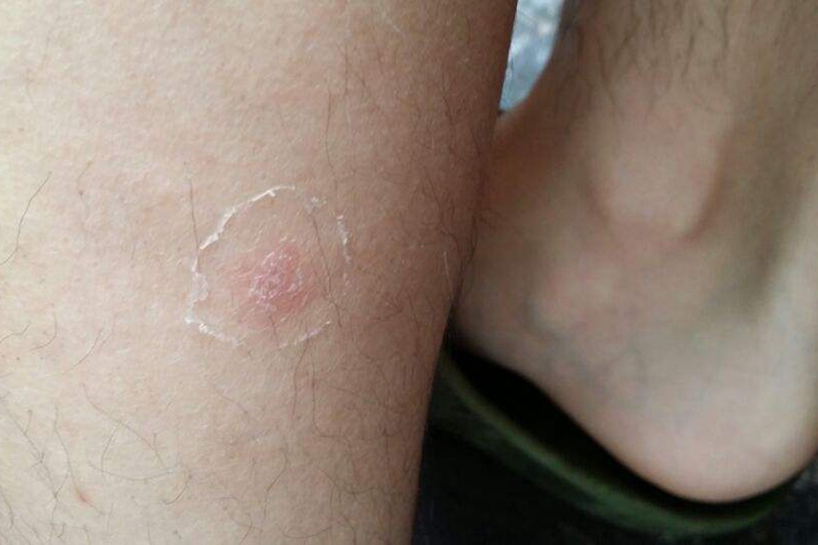 银屑病好转的迹象图