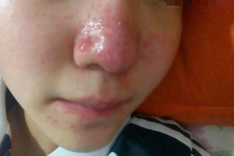 玫瑰痤疮鼻子两侧长小痘痘图