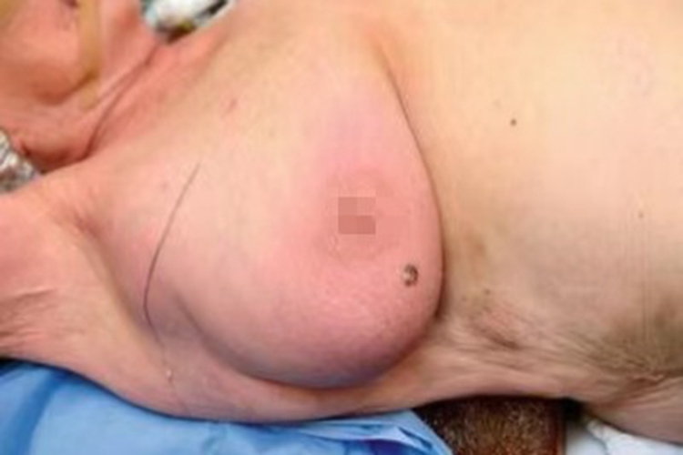 乳房肉瘤乳房红肿图