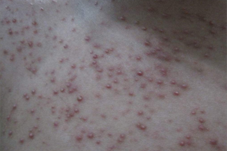 马拉色菌毛囊炎胸前长丘疹图