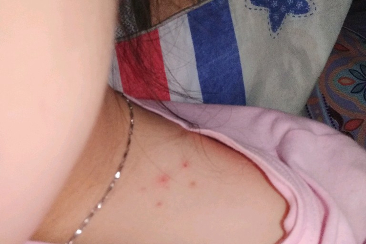 锁骨毛囊炎疙瘩图 锁骨毛囊炎疙瘩图