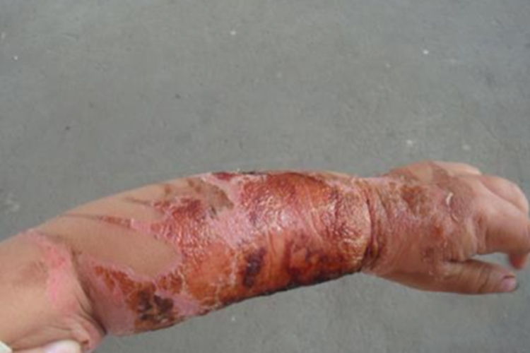 火碱烧伤皮肤图