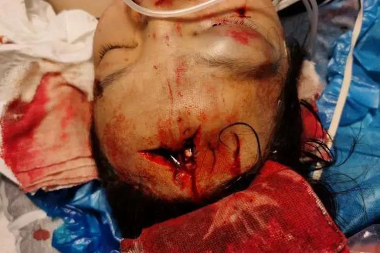 开放性颅脑损伤前额症状图 开放性颅脑损伤前额症状图