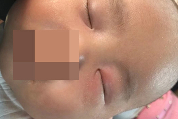 新生儿泪囊炎单眼肿胀发红图 新生儿泪囊炎单眼肿胀发红图