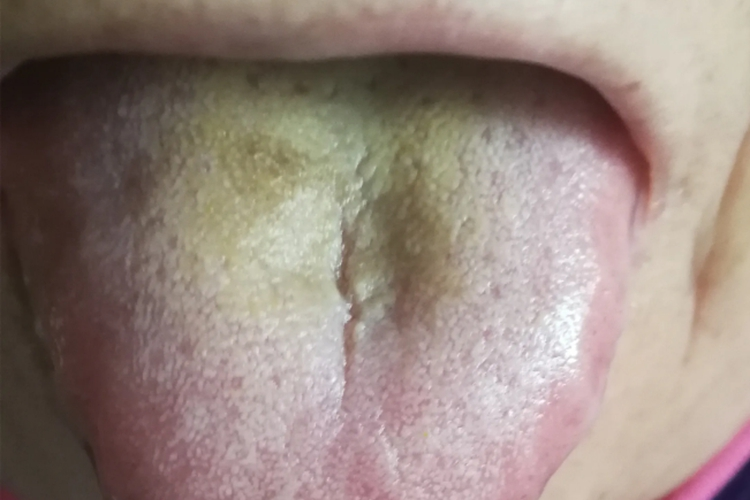 淡黄苔图 淡黄苔图