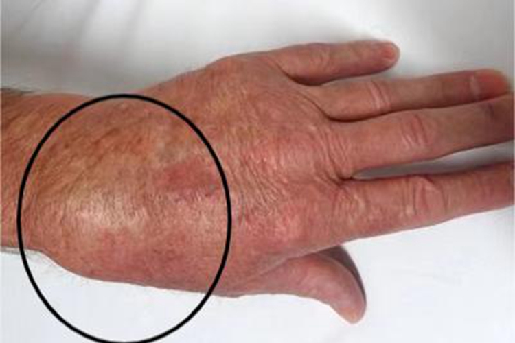 肩手综合征疼痛期大包图