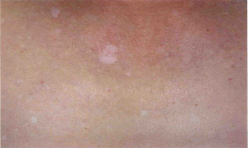 老年性点状白斑图 老年性点状白斑图