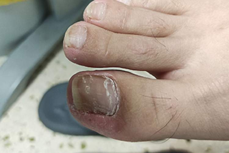 甲真菌病脚趾甲竖纹图