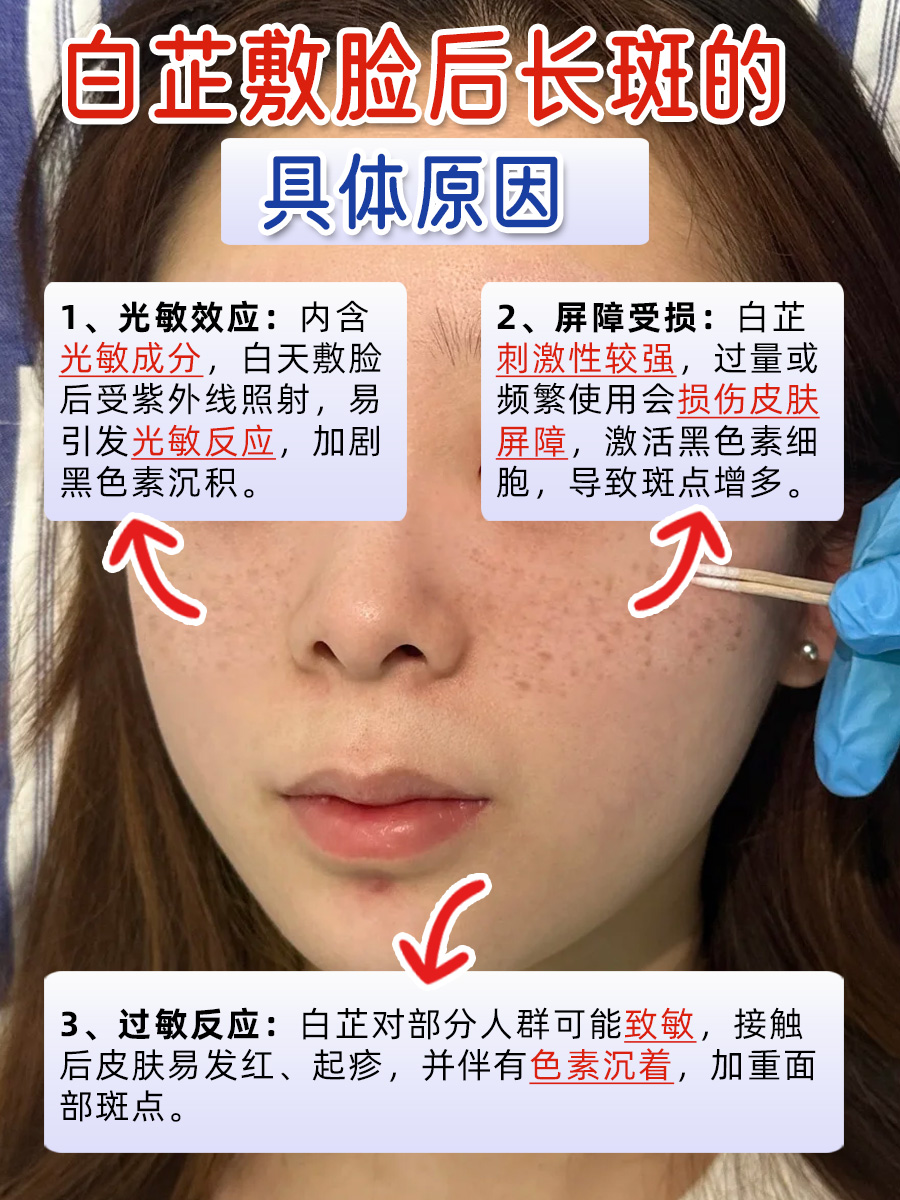 专业解读：白芷敷脸后长斑，原因竟然在这里！