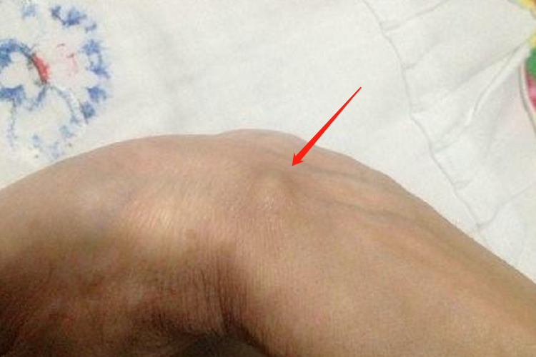 手腕内侧腱鞘炎图