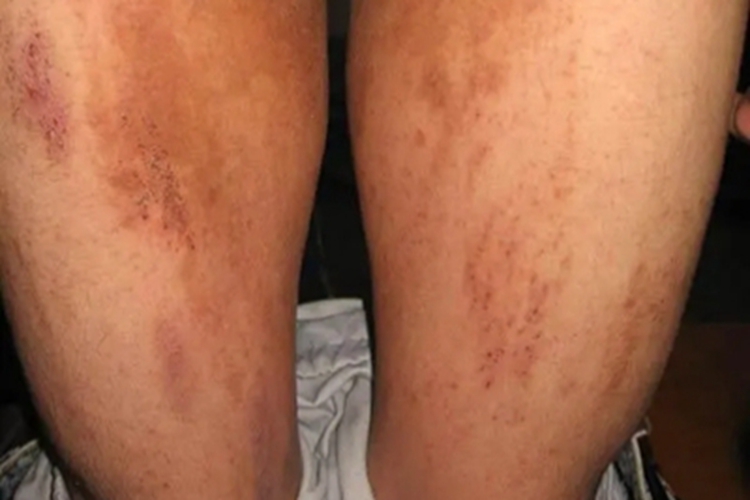 瘙痒症大腿长斑图